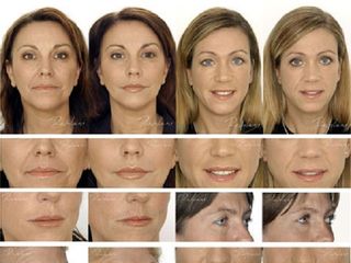 Antes y despues de rellenos faciales