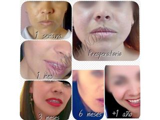 Antes y después de Bichetomia