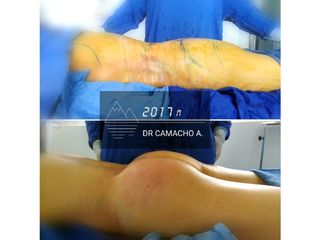 Antes y después de Aumento de glúteo con transferencia de grasa