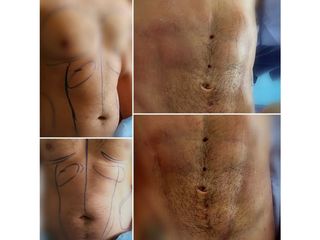 Antes y después de Definición HD de abdomen 