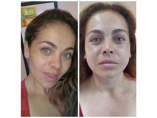 Antes y después de Bichectomia ( 1 mes PO)
