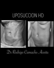 Antes y después de Liposucción HD