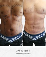Antes y después de Liposucción