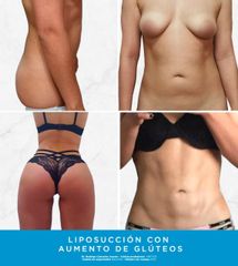 Antes y después de Liposucción con aumento de glúteo 