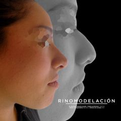 Antes y después de Rinomodelación (aplicación de acido hialurónico en nariz) 