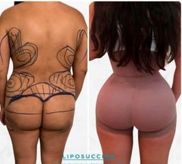 Antes y después de Lipoescultura