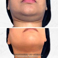 Antes y después de Liposucción de papada 