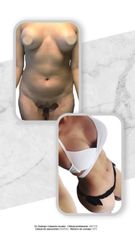 Lipoescultura - Dr. Rodrigo Camacho Acosta