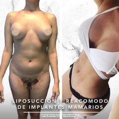 Antes y después de Lipoescultura y recambio de implantes mamarios - Dr. Rodrigo Camacho Acosta