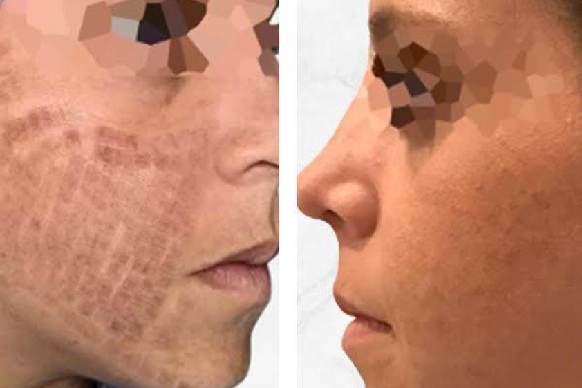 Láser CO2 Fraccionado antes y después - 661144