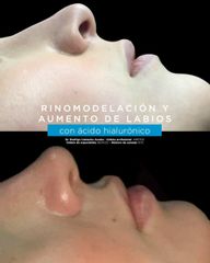 Antes y después de Rinomodelacion y aumento de labios 
