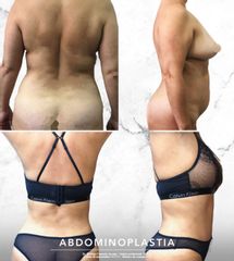 Antes y después de Abdominoplastia