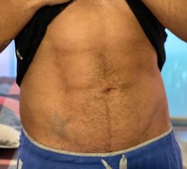 Resultado de Lipoescultura con marcación abdominal