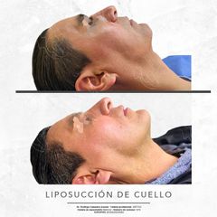 Antes y después de Liposucción de cuello 