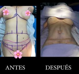 Antes y después de Abdominoplastia 