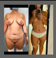 Antes y después de Lipoabdominoplastia