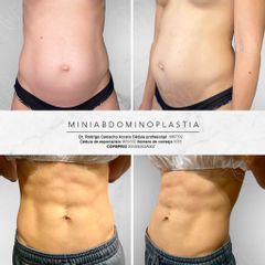 Antes y después de Mini abdominoplastia