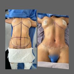 Antes y después de Lipo Abdominoplastia 