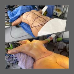 Antes y después de Lipoabdominoplastia 