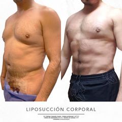 Antes y después de Liposucción 