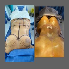 Antes y después de Lipoabdominoplastia