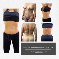 Antes y después de Lipoabdomindoplastia 