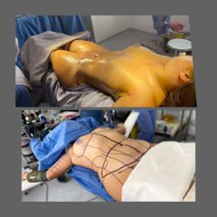 Lipoabdominoplastia - Dr. Rodrigo Camacho Acosta