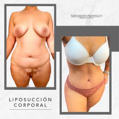 Liposucción - Dr. Rodrigo Camacho Acosta
