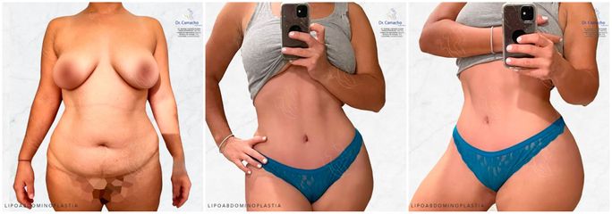 Lipoabdominoplastia - Dr. Rodrigo Camacho Acosta