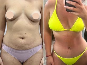 Abdominoplastia antes y después - 870205