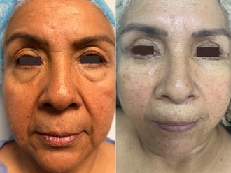 Blefaroplastia antes y después - 870207