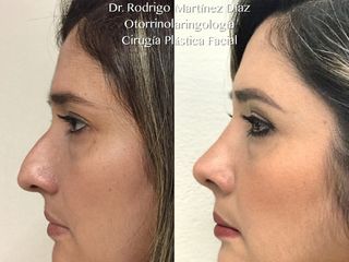 Antes y después de Rinoplastia