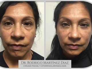 Antes y después de Blefaroplastia