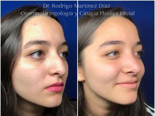 Antes y después de Rinoplastia