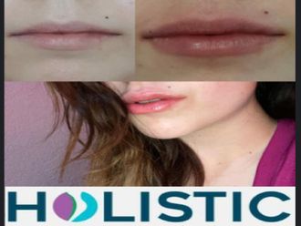 Aumento de labios - 687097