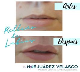 Antes y después de Relleno de labios