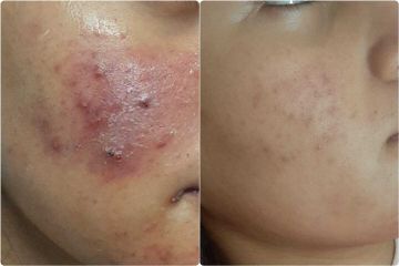Antes y después de Tratamiento antiacné