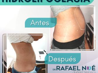 Tratamientos anticelulíticos antes y después - 827706