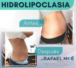 Hidrolipoclasia - Dr. Rafael Noé Juárez Velasco