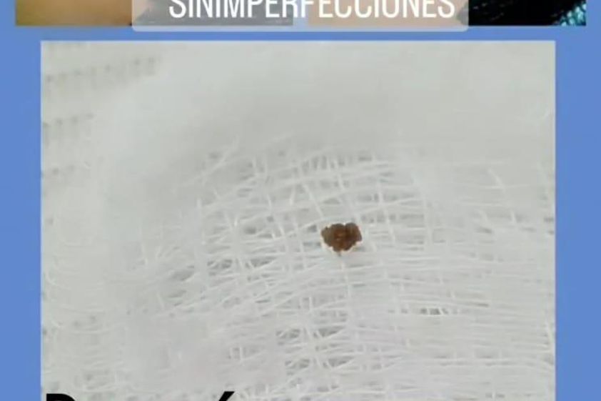 Eliminación de verrugas antes y después - 849970