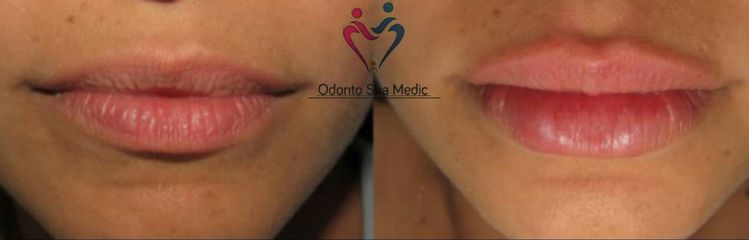 Aumento de labios - Odonto Spa Medic