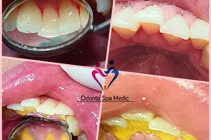 Blanqueamiento Dental antes y después - 850981