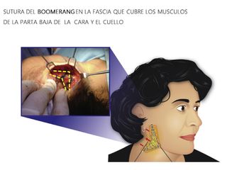 Sutura del Boomerang