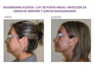 Antes y después de Boomerang-plastia 