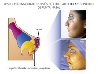 Resultado después de colocar el ICEA e injerto