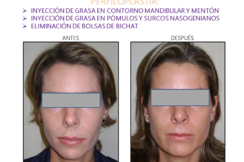 Cirugía facial antes y después - 554129