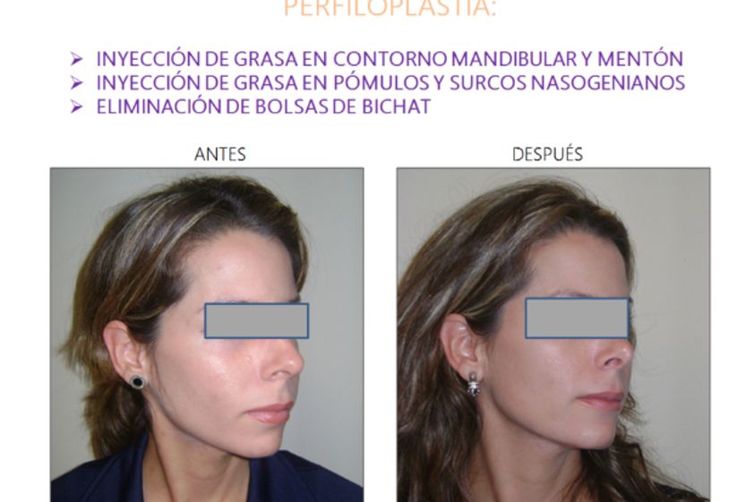 Cirugía facial antes y después - 554130