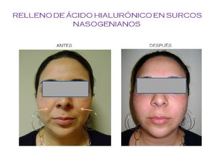 Antes y después de Ácido Hialurónico en surcos nasogenianos