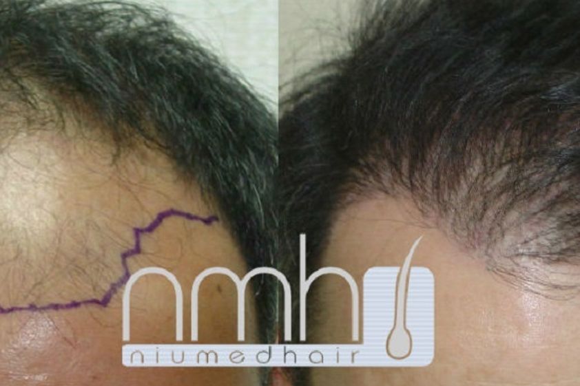 Trasplante de cabello antes y después - 569665