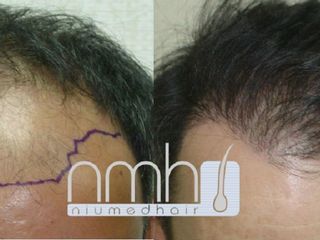 Microtrasplante de cabello